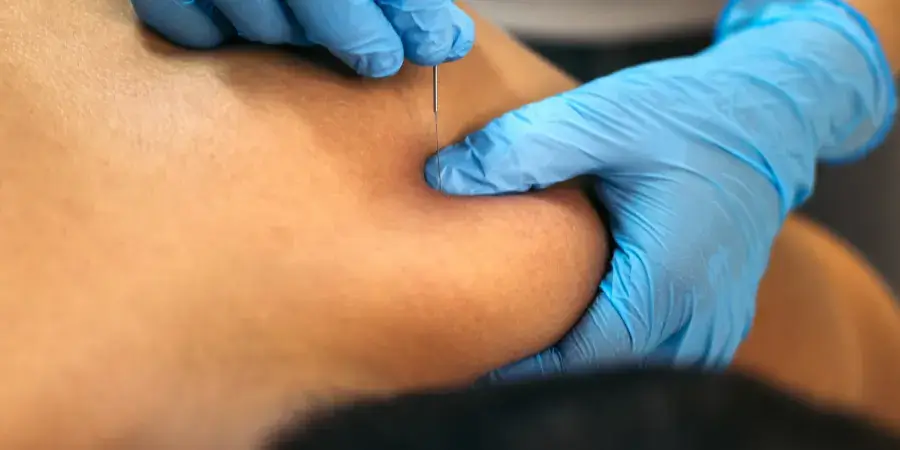 dry needling in ottawa at physiocare
