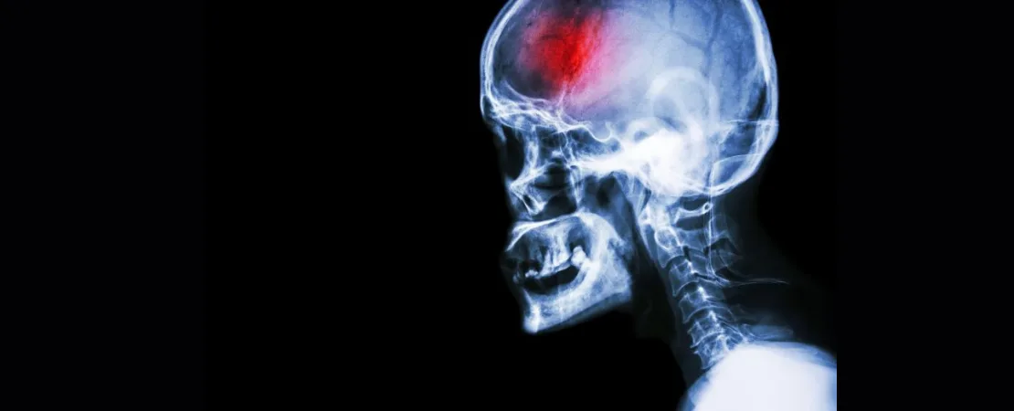 Understanding Stroke Rehabilitation