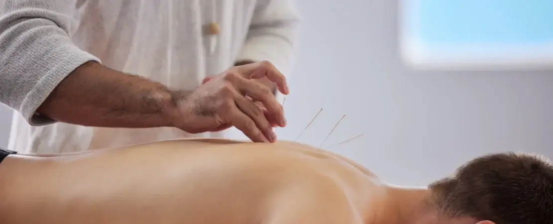 Acupuncture therapy at physiocare