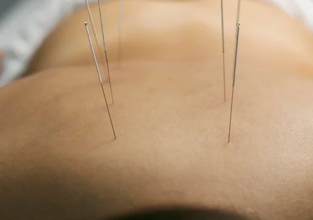 9 Common Concerns About Acupuncture Treatment in Ottawa