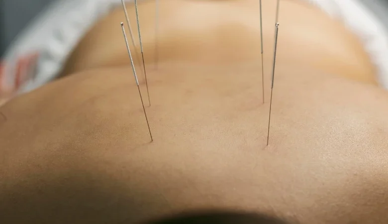 9 Common Concerns About Acupuncture Treatment in Ottawa