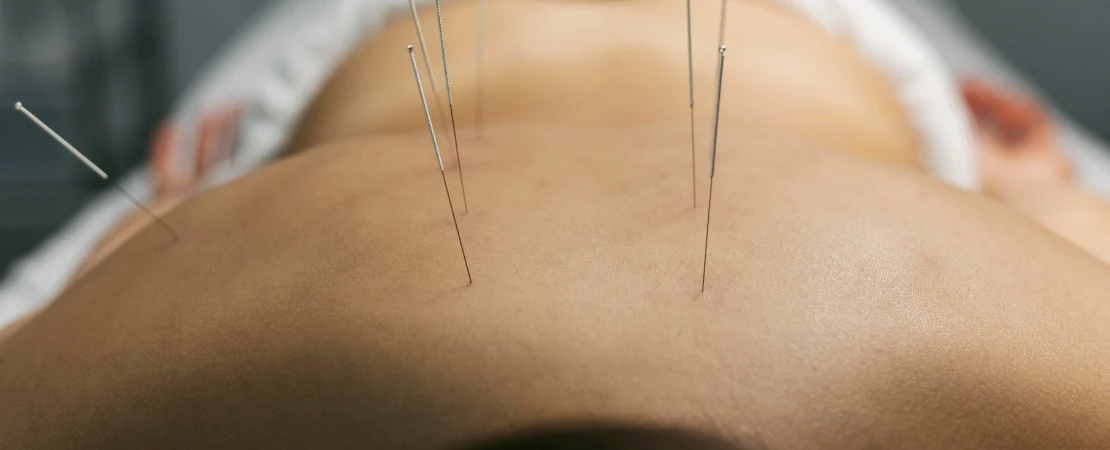 acupuncture therapy in Ottawa at physiocare
