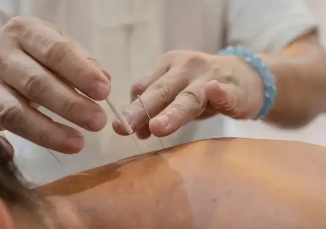 Acupuncture: Is It Worth It? A Physiotherapist’s Honest Take
