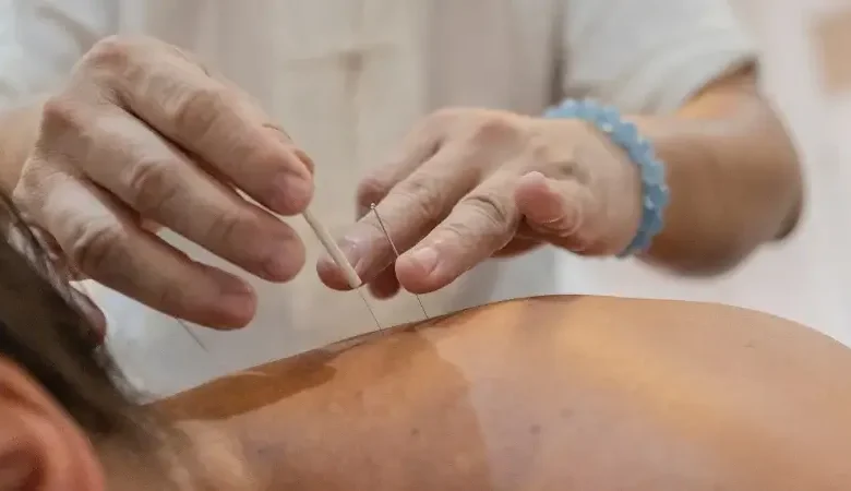 Acupuncture: Is It Worth It? A Physiotherapist’s Honest Take